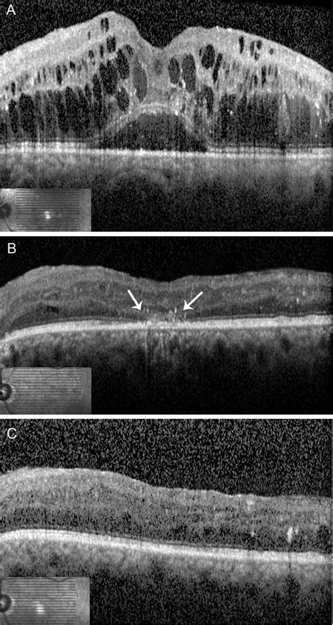 A Preoperative Optical Coherence Tomography Oct Showing Diffuse Download Scientific Diagram