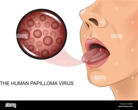 Vectores De Virus Del Papiloma Humano Fotograf As E Im Genes De Alta