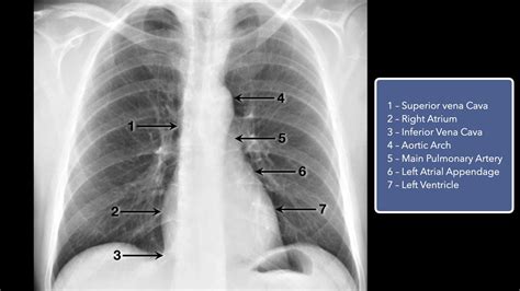 Basic Chest X Ray Interpretation Tips And Pointers To See It All