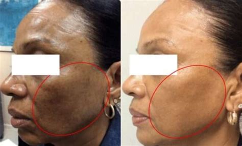 Pigmentation Treatment Skin Studio