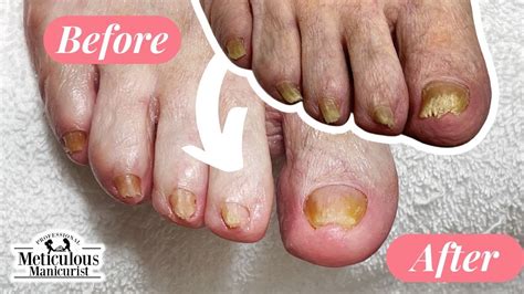 Pedicure Beauty Series Rams Horn Toenail Transformation Youtube