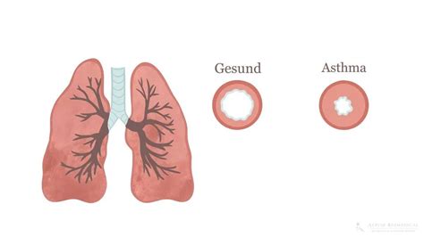 Asthma Symptome Ursachen Behandlung Alpine Biomedical