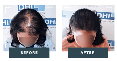 Dhi Hair Transplant Female Dhi Malaysia