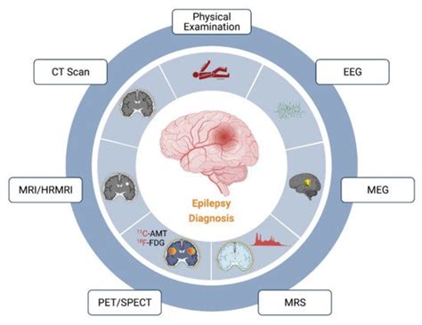 Diagnosis Of Epilepsy Encyclopedia Mdpi