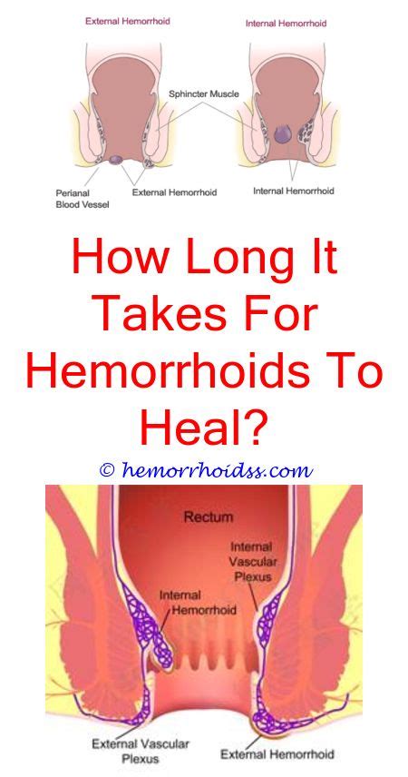 How Do You Get Hemorrhoids To Go Away Hemorrhoids Hemorrhoids