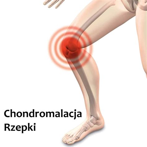 Chondromalacja Rzepki Poradnik Sposoby