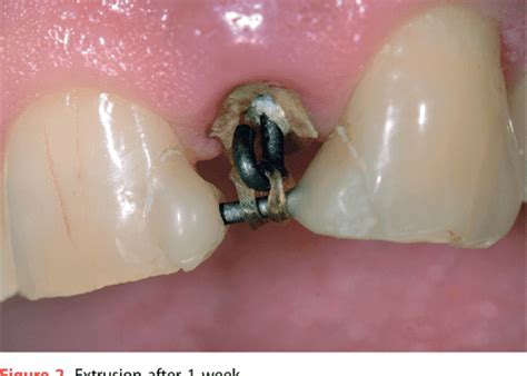 Figure 2 From Rapid Orthodontic Extrusion Of A Subgingivally Fractured Incisor Semantic Scholar