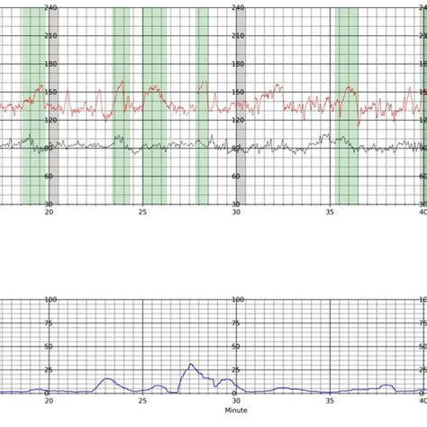 Final Fetal Heart Rate Fhr Trace Produced Postprocessing Of The Femom Download Scientific