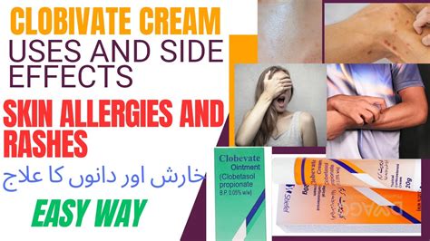 Clobivate Cream Clobivate K Faidey Clobetasol Clobivate Uses In