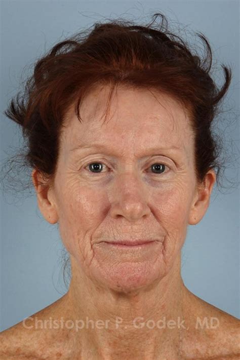 Before And After Laser Resurfacing In New Jersey The Godek Center