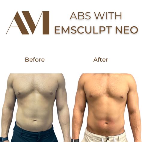 Before After Emsculpt Neo Miami Beach Dr Alonso Martin Md