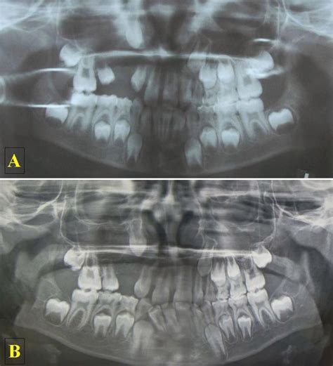 Radicular Cyst Of Primary Tooth Associated With Maxillary Sinus Bmj Case Reports