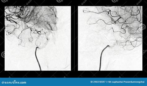 Cerebral Angiography Image From Fluoroscopy In Intervention Radiology Showing Cerebral Artery