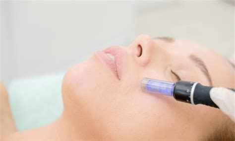 Rf Microneedling Richmond Hill — Acuvega Wellness Center