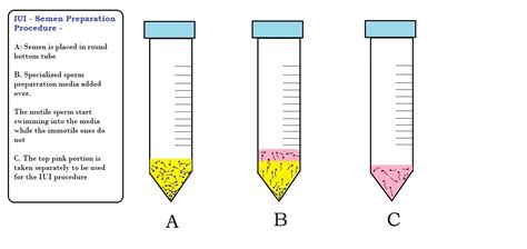 Iui Intrauterine Insemination Iui Procedure Iui Cost Iui