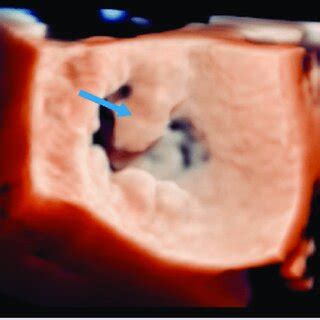 Three Dimensional Transesophageal Echocardiography Of Mitral Valve