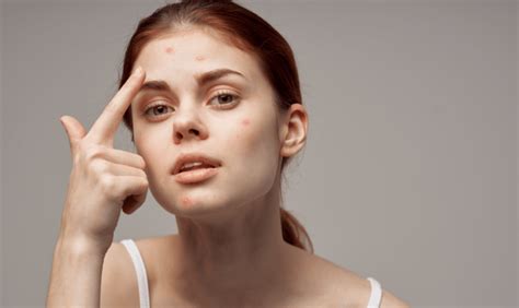 The Ultimate Guide To Acne Types Triggers And Treatments