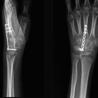 At 2 years after surgery, the arthrodesis was fused. No recurrence was ...