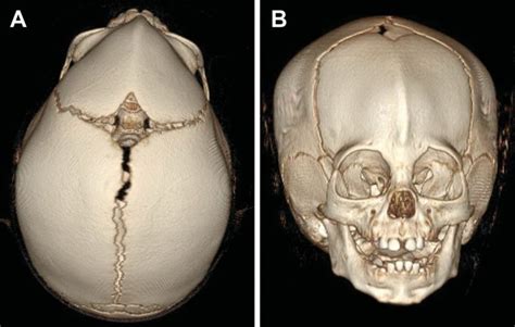 Craniosynostosis | UF Health, University of Florida Health