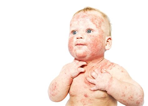 Dermatitis Atopic Overview Causes Symptoms Treatment