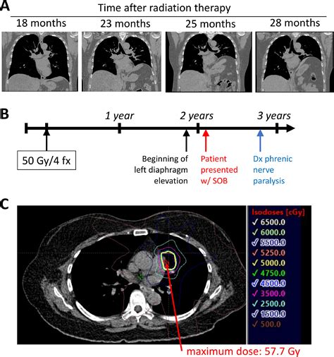 Unilateral Diaphragmatic Paralysis After Stereotactic Ablative