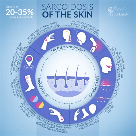 Sarcoidosis Erythema Nodosum