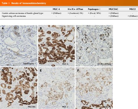 Table 1 From Gastric Adenocarcinoma Of Fundic Gland Type With Signet