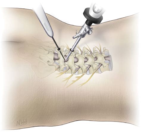 Endoscopic Spine Surgery Benefits At Debra Cushman Blog