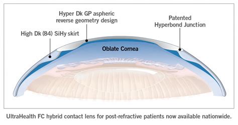 Synergeyes New Oblate Design Hybrid Lens To Launch Nationwide Synergeyes