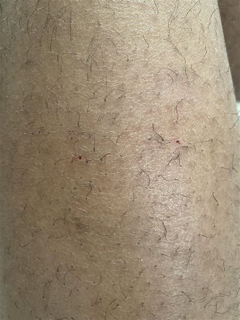 Hiv Marks Rhiv