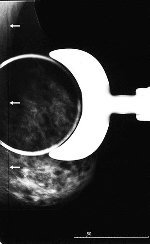 Optimizing Digital Mammographic Image Quality For Full Field Digital