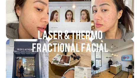 First Laser Thermo Fractional Facial Experience At Skin Laundry I