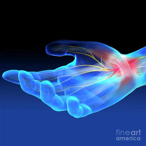 Carpal Tunnel Syndrome Photograph By Fernando Da Cunhascience Photo