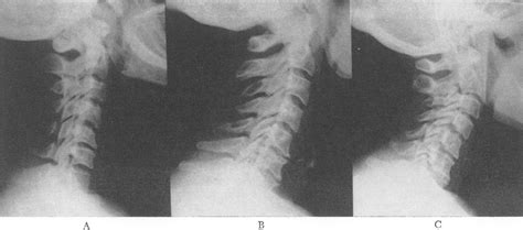 Osteoarthritis Of The Cervical Spine — Stage And Treatment Nejm