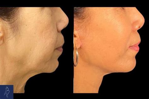 Le lifting cervico facial ou lifting du visage et du cou à Paris