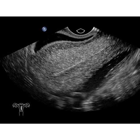 Blue Phantom Transvaginal Sonohysterography And Sonosalpingography