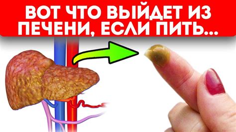 Советская чистка печени! Из печени вышла такая гадость, после того, как ...