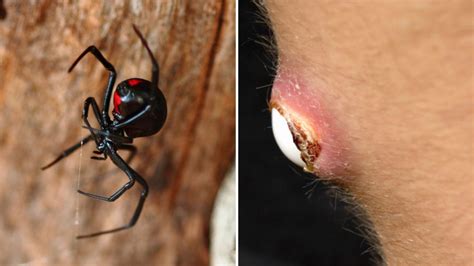 Qué hacer si te muerde una araña viuda negra o violinista estando