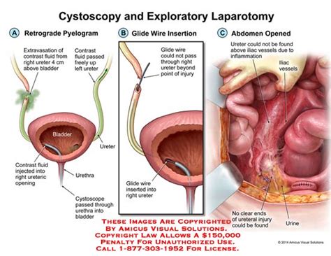 AMICUS Illustration Of Amicus Surgery Cystoscopy Exploratory Laparotomy