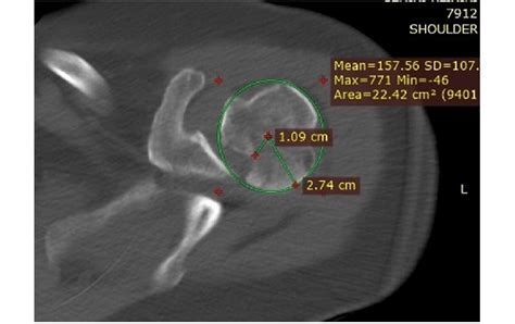 2nd Patient Ct Scan Confirming Psd With Associated Reverse Hill Sachs Download Scientific