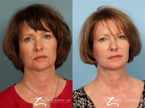 Ultherapy Before After Gallery