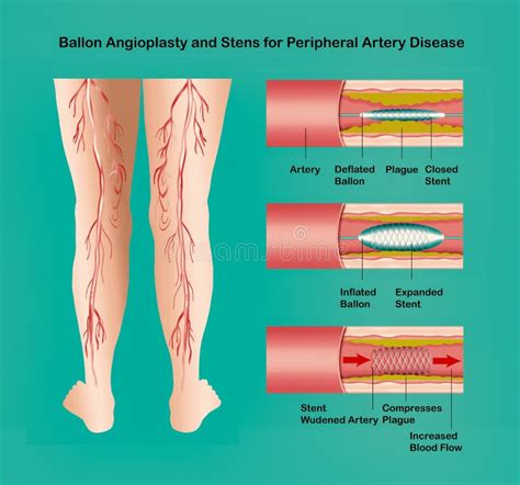 Diagram Showing Angioplasty For Peripheral Artery Disease Illustration