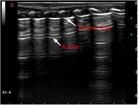 Frontiers The Application Of Pulmonary Ultrasound In Neonatal Ventilator Associated Pneumonia