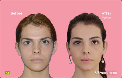 Facial Feminization Surgery Vintologi