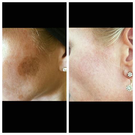 Cryopen Cryotherapy Mole Wart Skin Tag Removal No Referral