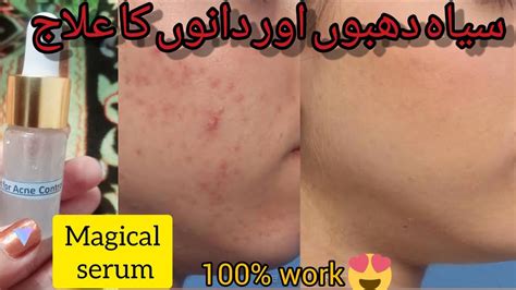 Diy Acne Control Serum Acne Treatment At Home Remove Pimple Acne Scar