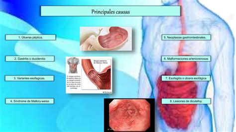 Sindrome Hemorragico Digestivo Ucs Pptx Descarga Gratuita