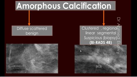 4 Sonomammography Acr Birad Breast Calcification Youtube