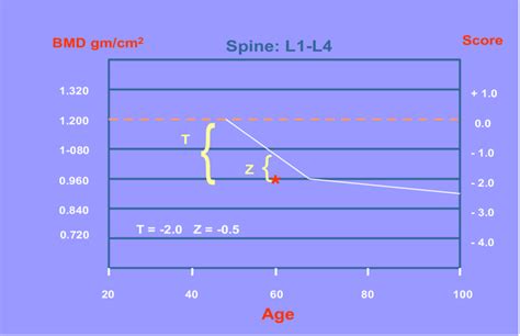 Bone Mineral Density T Score And Z Score Download Scientific Diagram