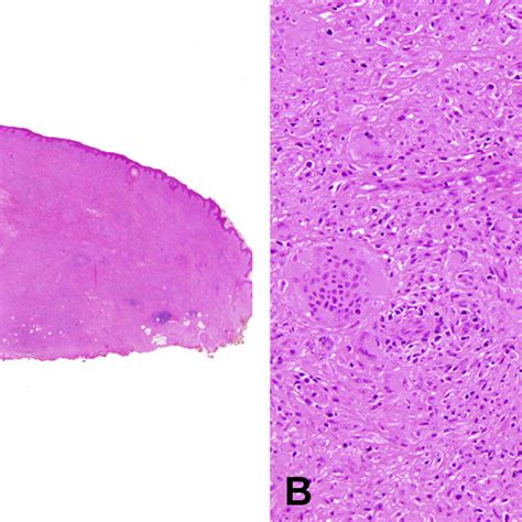 A Histopathology Of Vulvar And Right Thigh Lesions Skin Biopsy